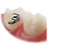 2nd molar, Mini tubes