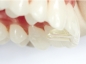 Preview: Ersatztips für Tiger Dental MiniMold (palatinaler Aufbiss)