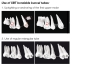 Preview: XBT Klebe-Bukkalröhrchen zur Aufrichtung / Verankerung, Zahn 16, 26