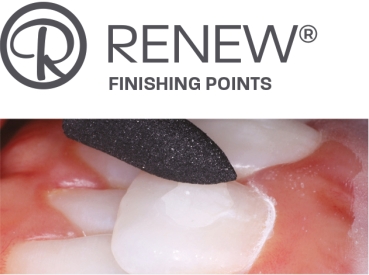 Renew™ System - Finishing points