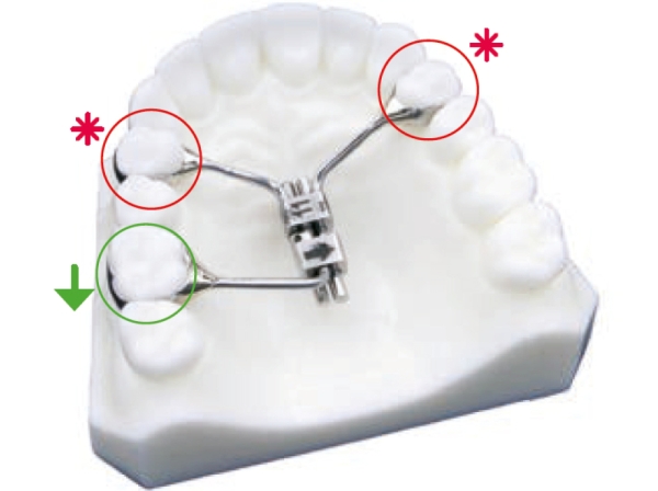 Multifunctional orthodontic screw, 3 arms