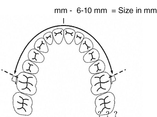 Molar Distalizing Arch, Size 2 (83 mm)