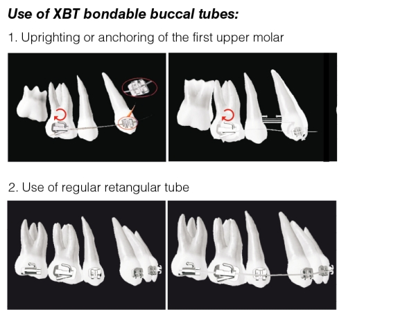 XBT - Bondable Buccal Tubes for uprighting / anchorage of 1st molar (tooth 16, 26)