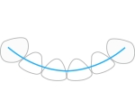 ProTain™ – digital retainer, lower jaw